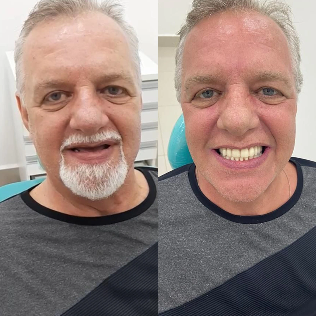 Antes e Depois - 06